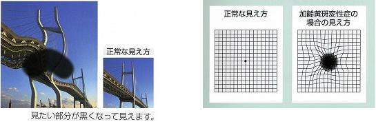 加齢黄斑変性症の見え方